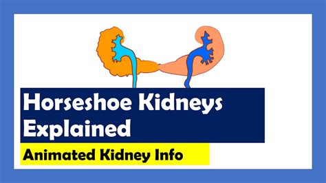 horseshoe kidney nhs